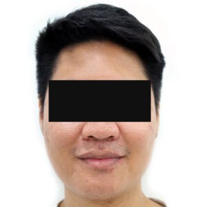 Fractional CO2 Laser before front image