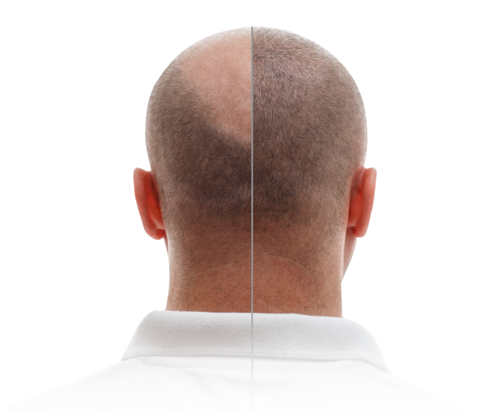 head balding man before after hair transplant surgery man losing his hair has become copy 2 1.png