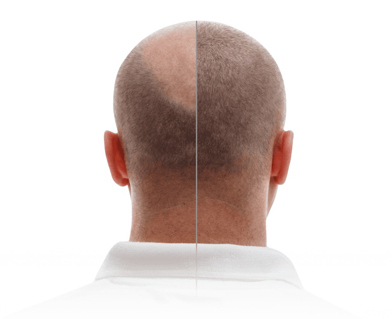 Hair Restoration - Fue Hair Transplant - Hair Transplant