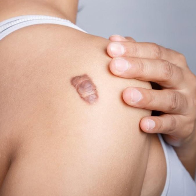 keloid scars.jpg