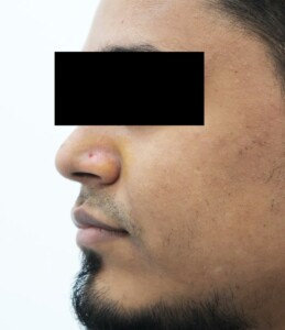 Skin Tag After image