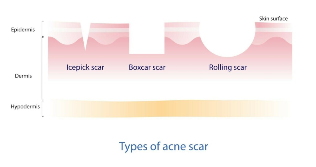 scar removal procedure