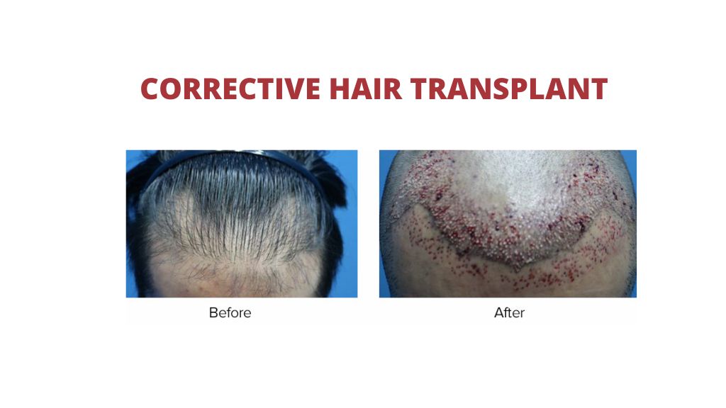 corrective hair transplant 1.jpg