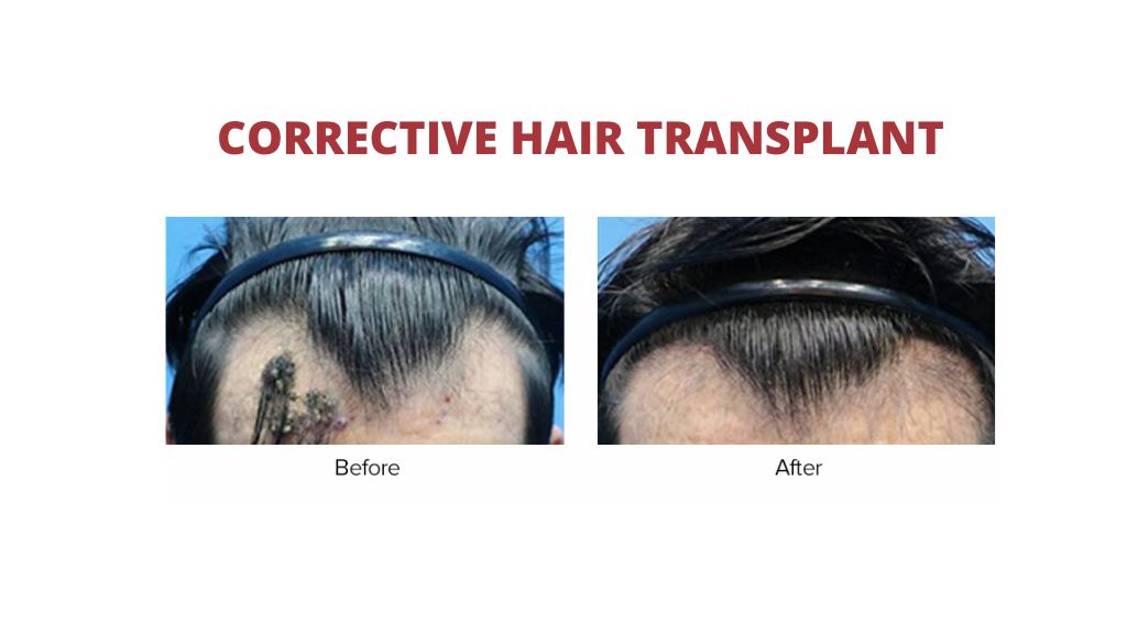 corrective hair transplant 2nd 1.jpg