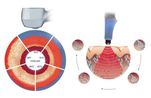 exilis ultra 360