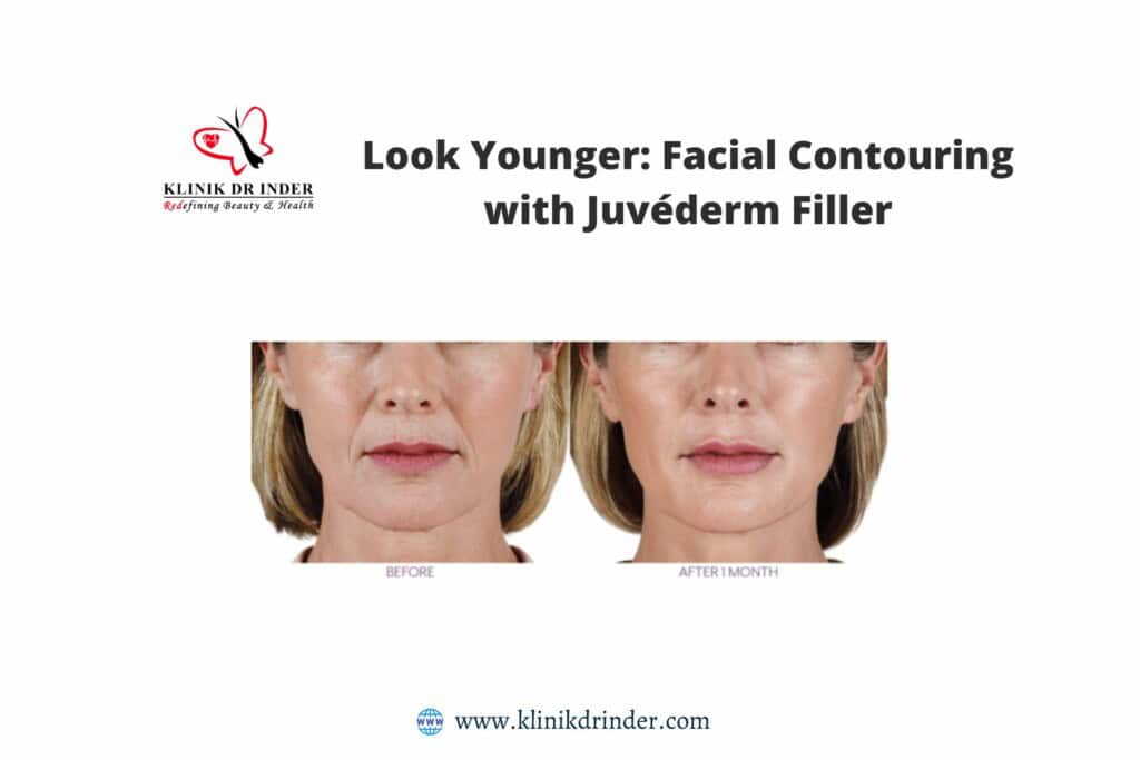 juvederm filter.jpg