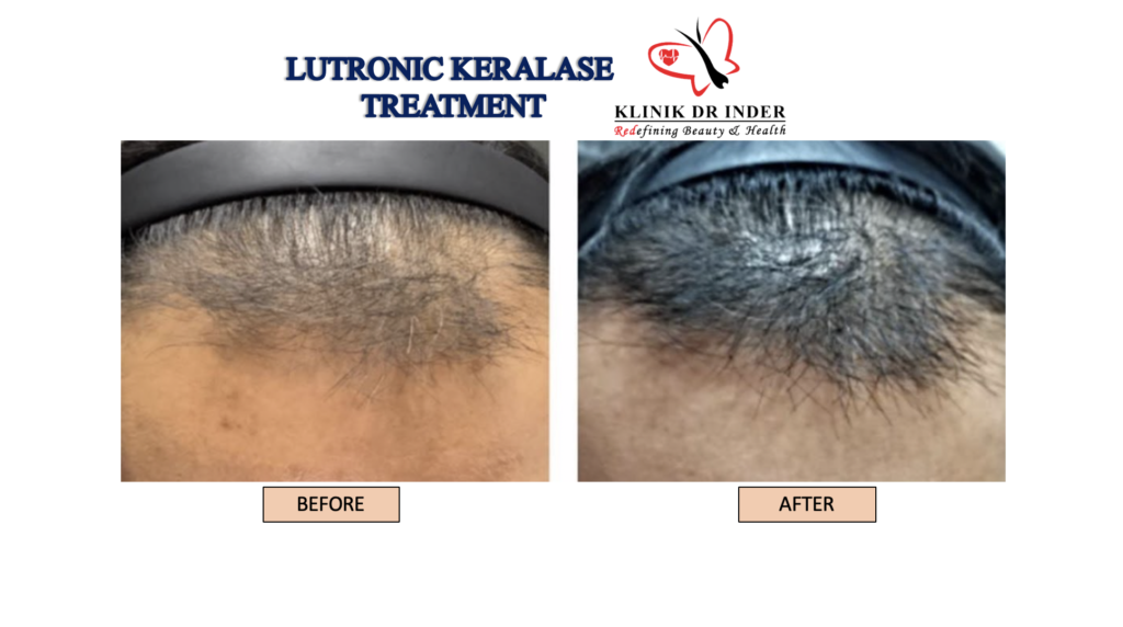 lutronic keralase before after .png