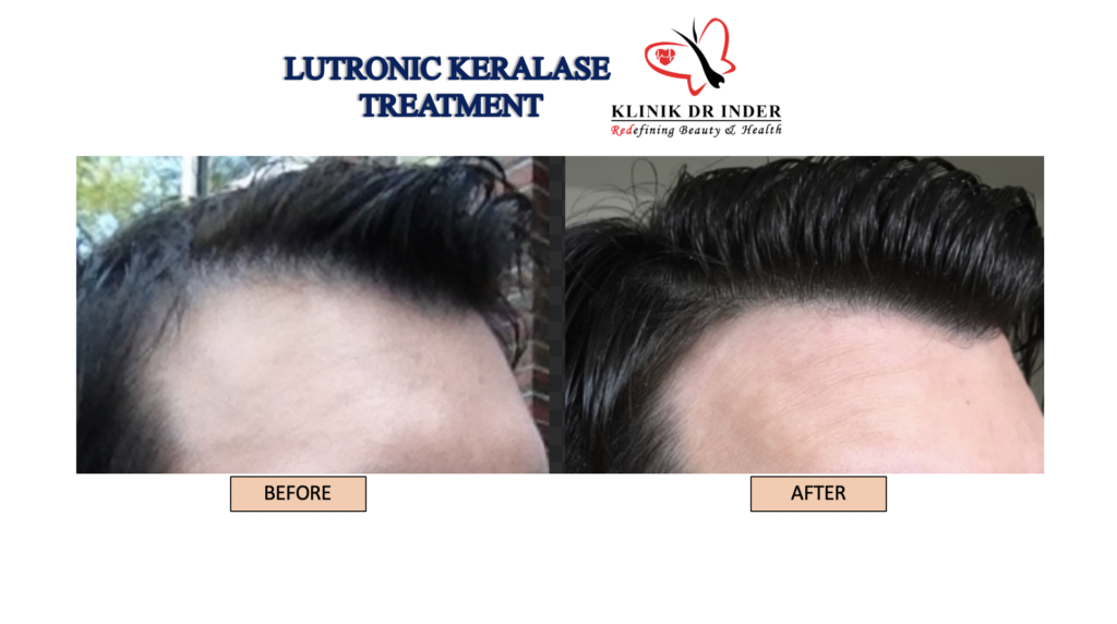 lutronic keralase before after.png