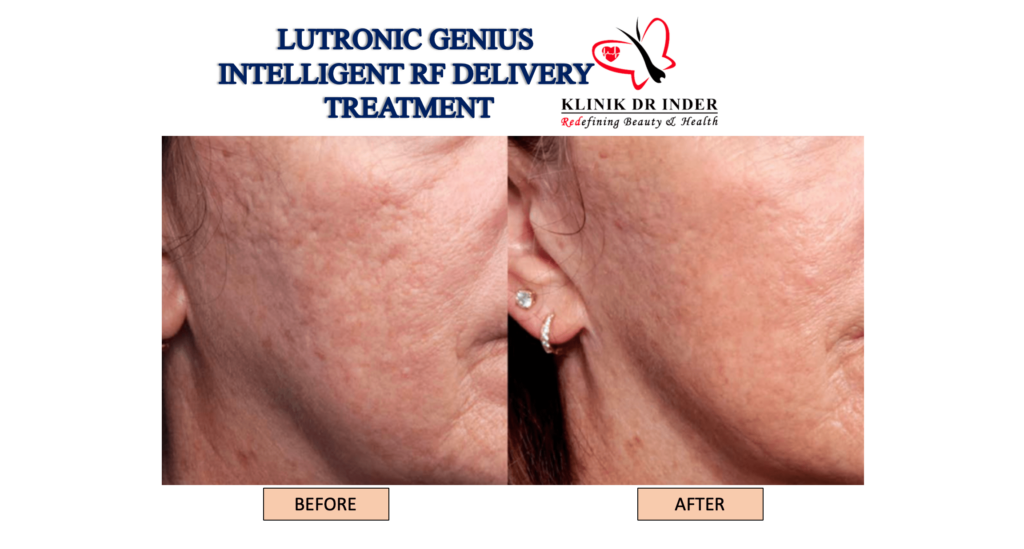 lutronic genius intelligent micro needling before after.png