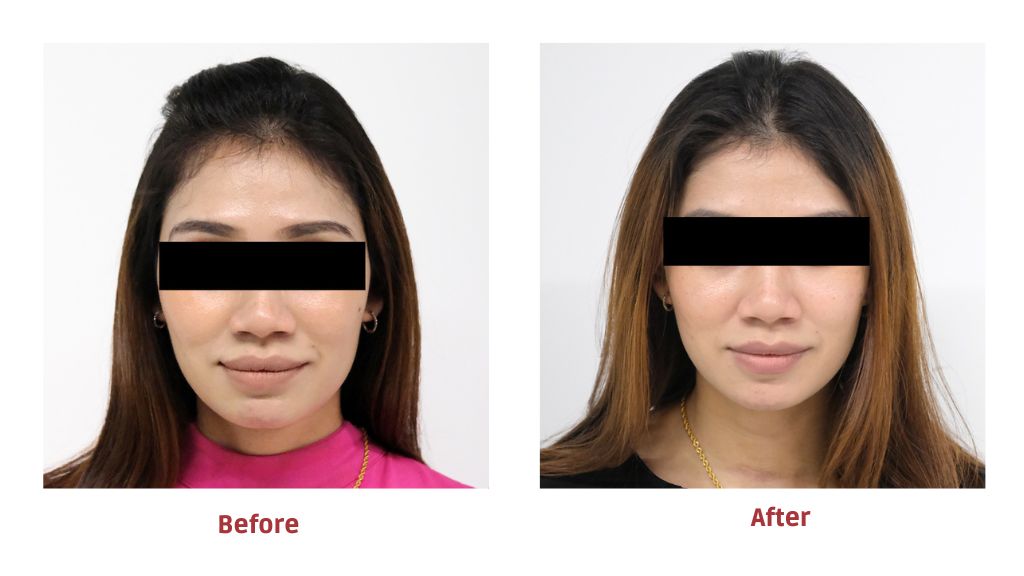 medlite c6 before and after