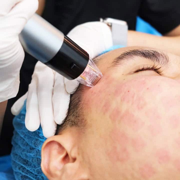 rf microneedlings.jpg