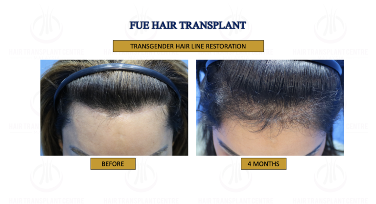 transgender hair transplant before after.png