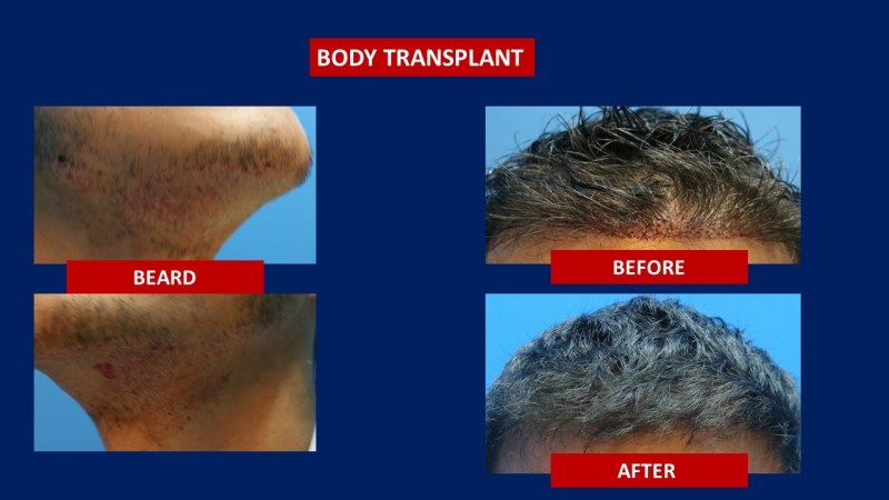 body hair transplant review.jpg