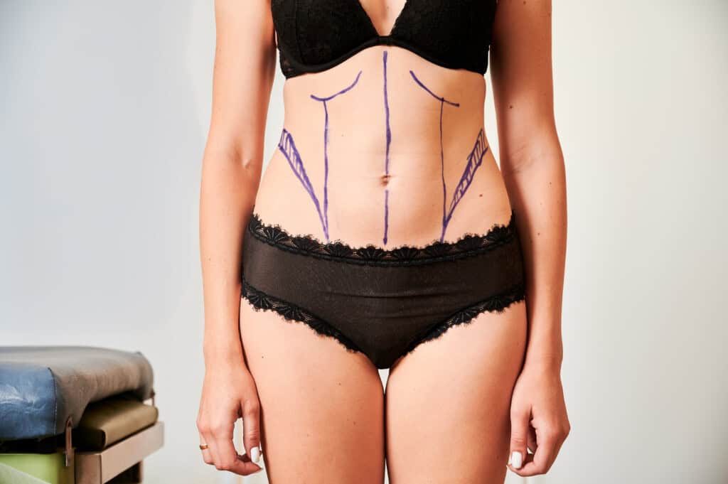 female patient body with marks for plastic surgery.