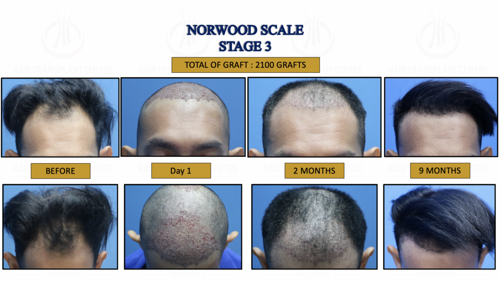 hair transplant, male pattern hair loss, bald
