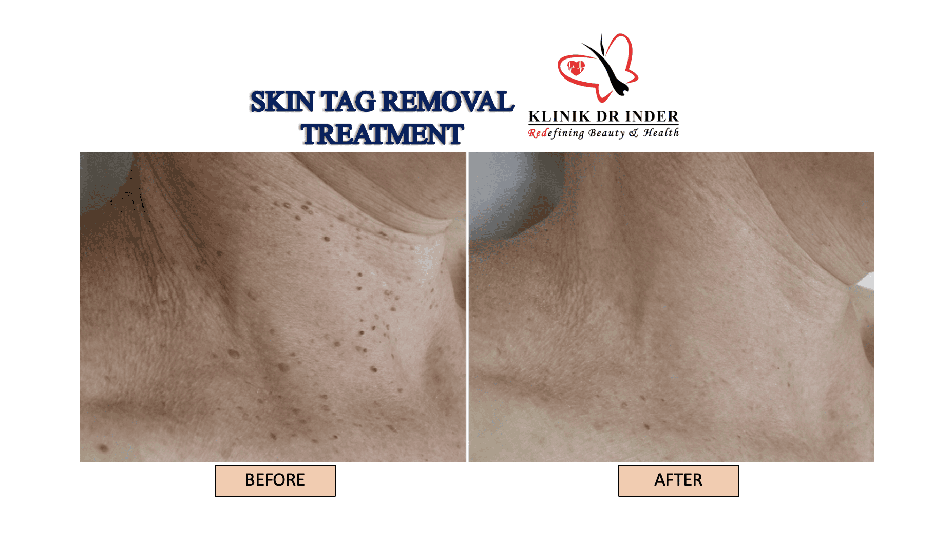 How Do I Treat & Prevent Skin Tags? - Klinik Dr Inder