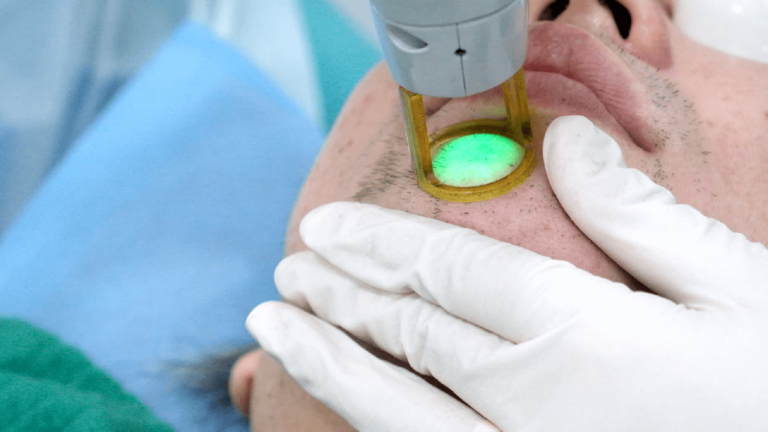 Laser hair Removal treatment for chin 2
