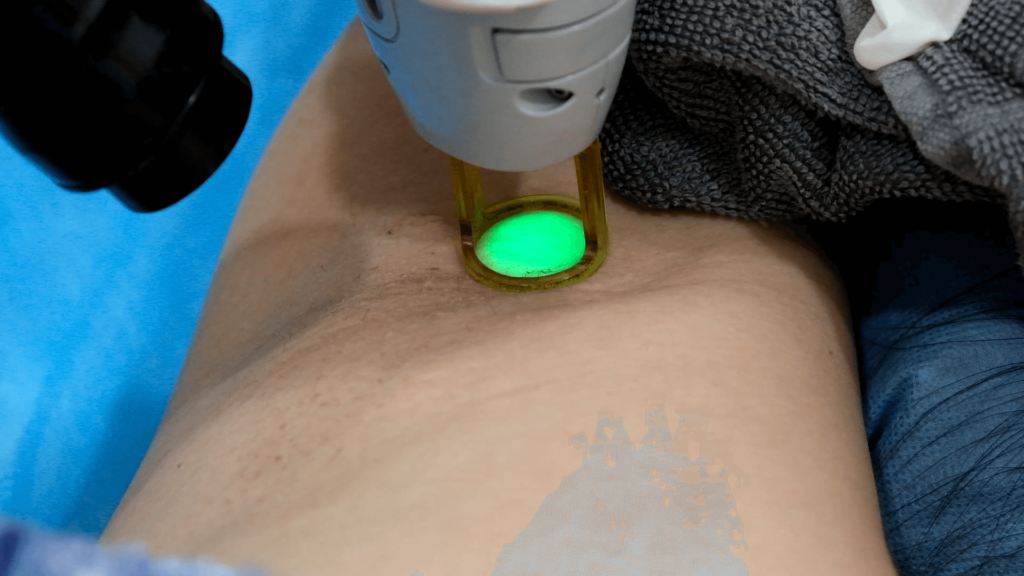 Laser hair Removal treatment for underarm