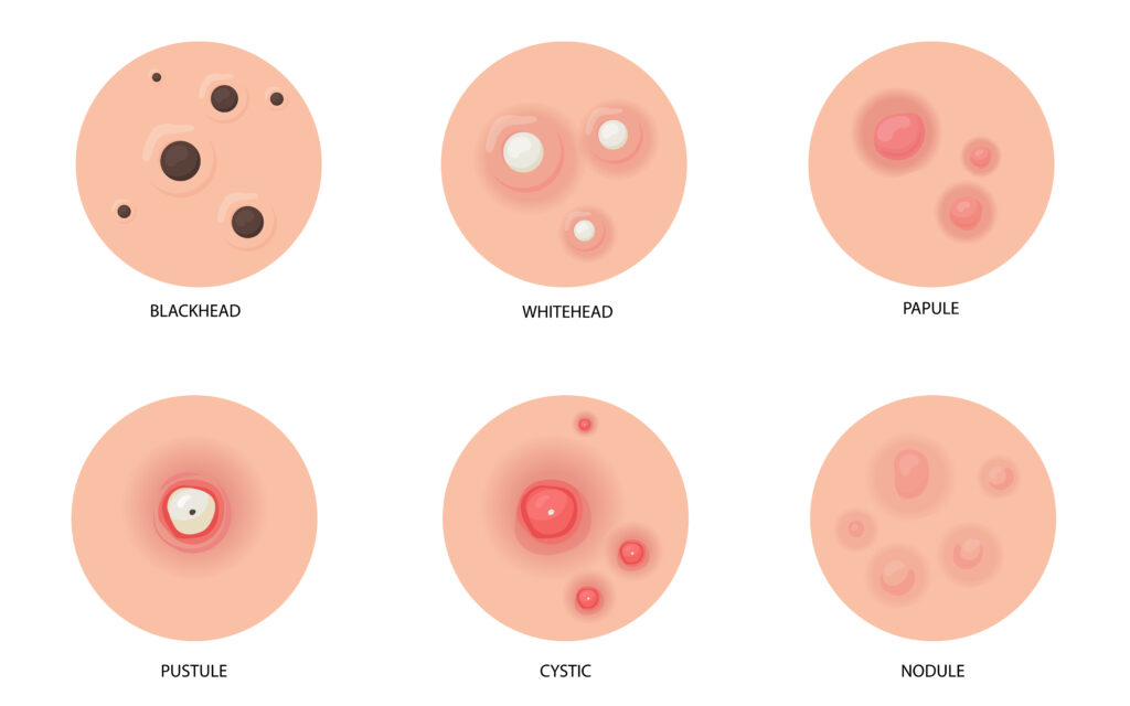 Different types of acne Scar