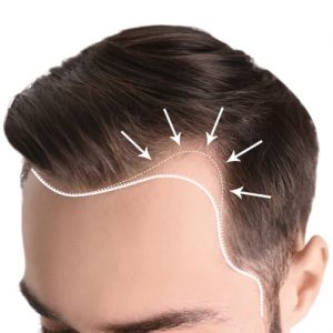Corrective Hair Transplant Corrective Hair Transplant for Male