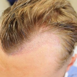 Corrective Hair Transplant 4 Corrective Hair Transplant 4