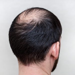 Crown hair Transplant 3 Crown hair Transplant 3