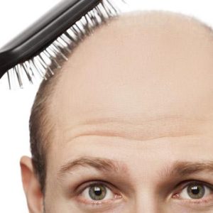 Crown hair Transplant 5 Crown hair Transplant 5