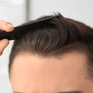 Lowering Hair Line 3 Lowering Hair Line 3