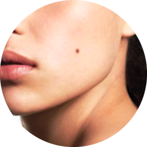 Mole Removal Mole Removal Treatment