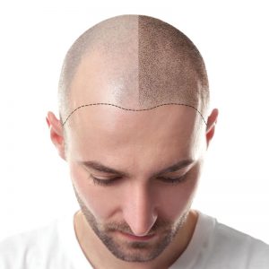 Scalp Micro Pigmentation (SMP) 1