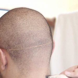 Scar Revision On The Scalp