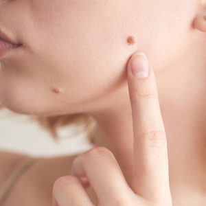 Skin tag Treatment Skin tag Treatment