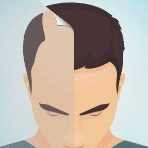 Transgender Hair Transplant 3 Transgender Hair Transplant 3