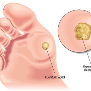wart removal treatment wart removal treatment